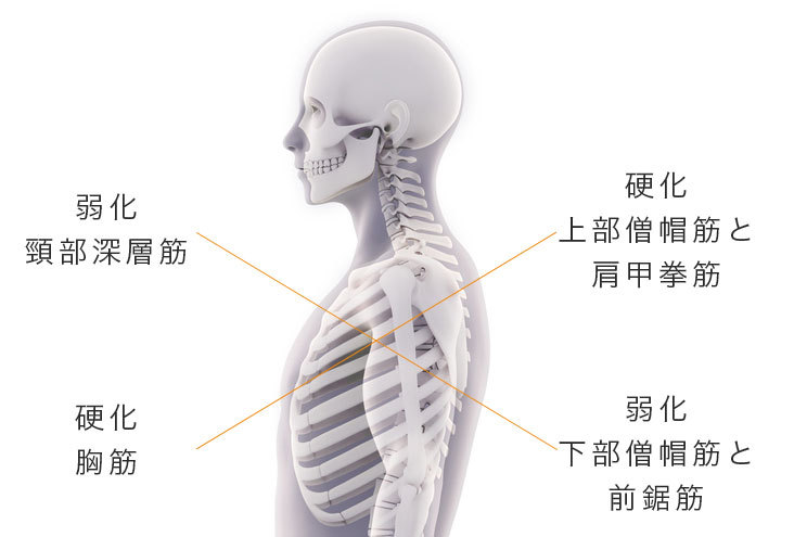 上位交差症候群